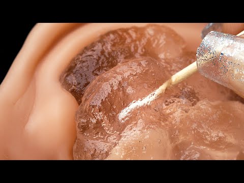 Видео: ASMR | Барабанная перепонка вибрирует | Глубокая чистка ушей густым гелем (НЕ ГОВОРИТЬ, ACMP)