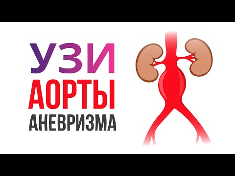 Видео: Аневризма аорты и разрыв аневризмы на УЗИ. 8 УЗИ критериев разрыва аневризмы аорты на УЗИ