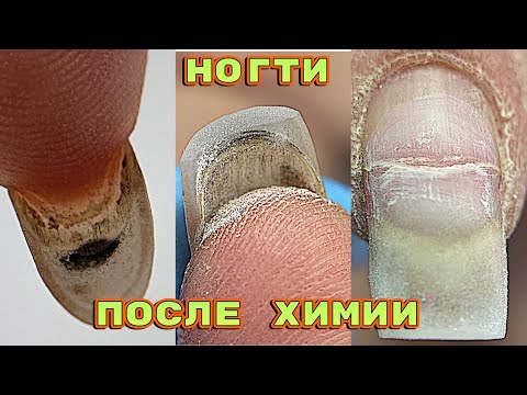 Видео: Ногти после Химиотерапии ч2 / Трещина в МЯСО 😐 / Что с ногтевой пластиной? Летний маникюр