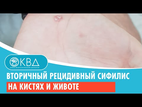 Видео: ✋ Вторичный рецидивный сифилис на кистях и животе. Клинический случай № 1024