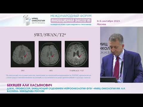Видео: Опухоли ЦНС лимфоидной природы: взгляд нейрохирурга на проблему в целом и возможности диагностики