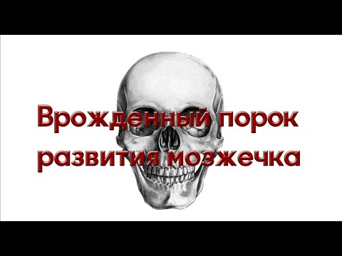 Видео: Диагностика аномалии Арнольда Киари врожденный порок развития мозжечка