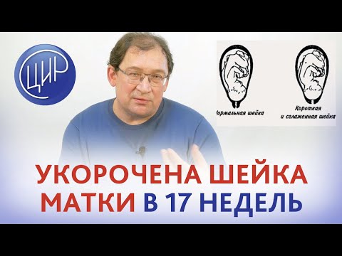 Видео: Укорочение шейки матки в 17 недель. Истмико-цервикальная недостаточность (ИЦН) Причина, что делать?