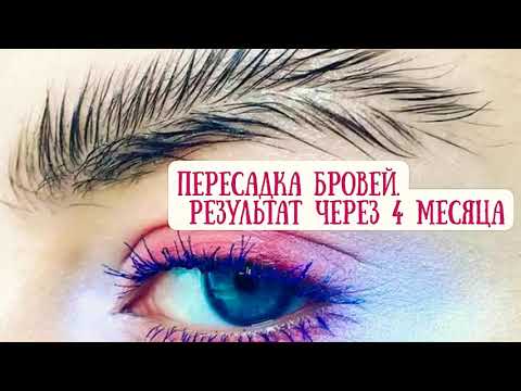 Видео: ПЕРЕСАДКА БРОВЕЙ ТРАНСПЛАНТАЦИЯ ВОЛОС В ЗОНУ БРОВЕЙ. ПЕРВЫЕ РЕЗУЛЬТАТЫ