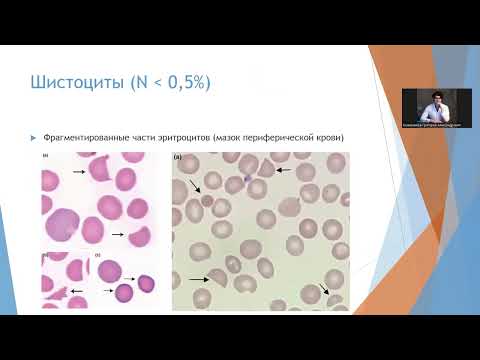 Видео: ОАК 1.2. Дифдиагноз анемий, лейкоцитозов и лейкозов