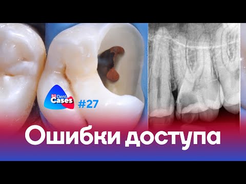 Видео: Ошибки эндодонтического доступа | Дентал Кейсы от BG #27
