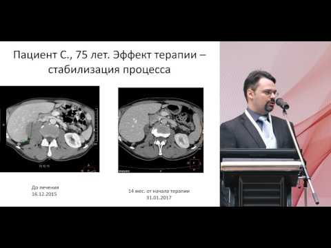 Видео: Осложнения терапии ингибиторами контрольных точек. Клинический случай 1