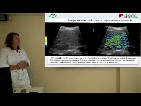 Видео: Лечение ГЭРБ у пациента с цирротической стадией гепатита С и обострением хронического панкреатита