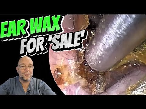 Видео: Ушная сера на продажу! 305 #ухо #ушнаясера #удалениеушнойсеры #длявас #fyp #asmr #asmrearwax #удо...