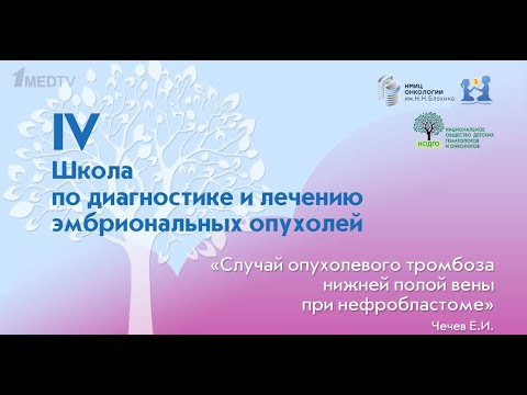 Видео: Чечев Е.И. - Случай опухолевого тромбоза нижней полой вены при нефробластоме