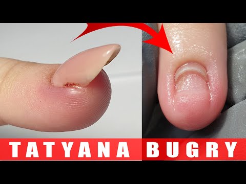 Видео: Сорвала НОГОТЬ 😱  Коррекция  ВВЕРХ растущих НОГТЕЙ / Татьяна Бугрий