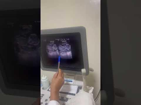 Видео: УЗИ ҚАТЕЛЕСТІ 100% ҚЫЗ ДЕП ҰЛ ТУДЫ