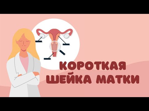 Видео: Короткая шейка матки - стоит ли бояться и помогает ли пессарий? @DrOlenaB