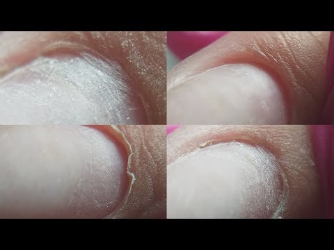 Видео: Приросшая кутикула/прилипшая кутикула/неподъемная кутикула.Что с ней делать ?😱