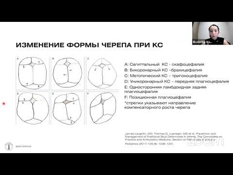 Видео: Краниосиностозы и другие деформации черепа у детей: на что обратить внимание лечащему врачу
