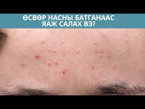 Видео: (eng) Насны онцлогийн арьс арчилгаа? Teenage acne skincare | AMKA AVARZED