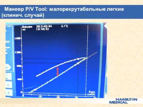 Видео: P-V tool и рекрутмент на аппаратах Гамильтон-Медикал  (кИВЛ14дек)  Сатишур О.Е.