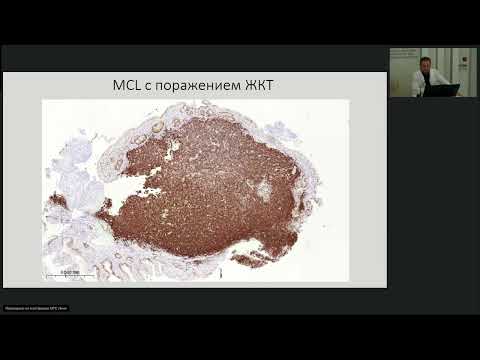 Видео: Лимфообщество: Лимфома клеток мантии