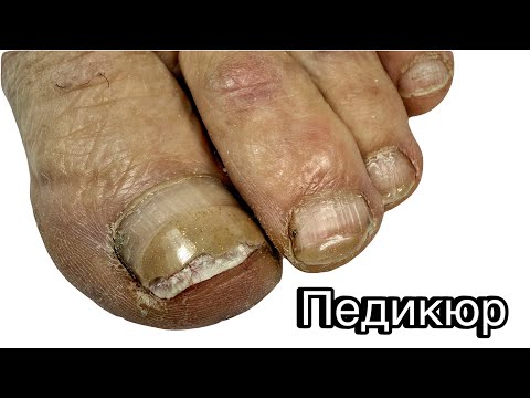 Видео: Аппаратный педикюр