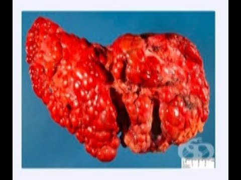 Видео: Академия "Здравословно": Цироза на черния дроб