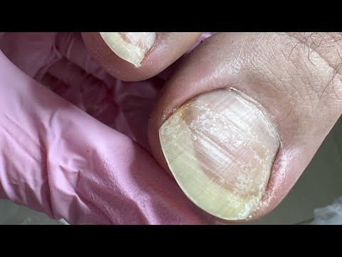 Видео: Мужской педикюр / Последствия отросших ногтей / Эксперимент над мужем