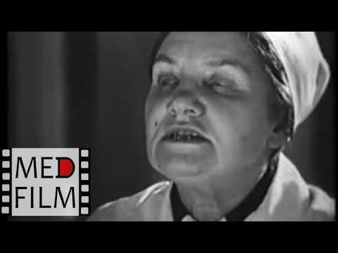 Видео: Круп, острый обструктивный ларингит. Академик Н.И.Нисевич © Acute obstructive laryngitis, croup