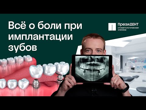 Видео: ПРАВДА О БОЛИ ПРИ УСТАНОВКЕ ЗУБНЫХ ИМПЛАНТОВ 🦷 | ПрезиДЕНТ 💚