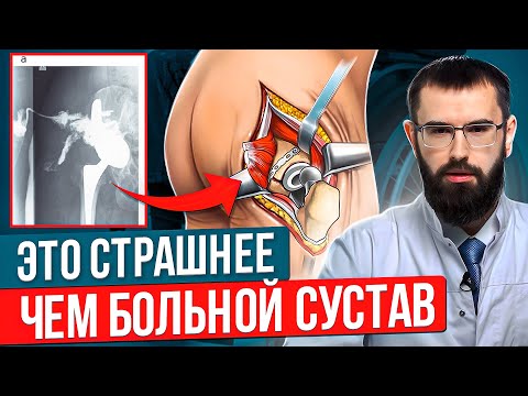 Видео: Самое страшное в эндопротезировании. Гной в суставе. Ревизионное эндопротезирование.