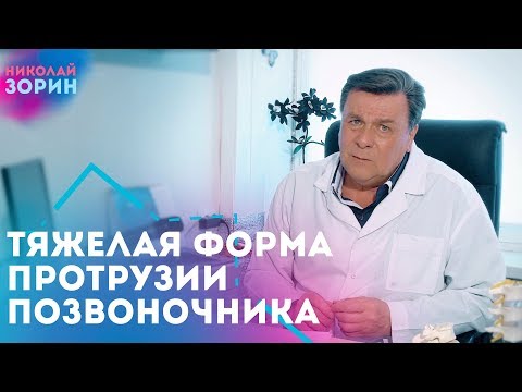Видео: Тяжелая форма протрузия межпозвонковых дисков. Нейрохируг Зорин Николай Александрович