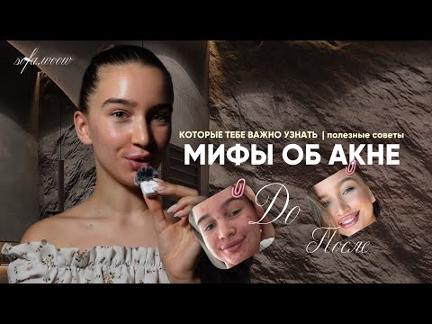 Видео: 🥲 ЭТИ СОВЕТЫ ИСПОРТЯТ ТВОЮ КОЖУ | МИФЫ ОБ АКНЕ
