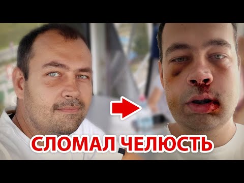 Видео: Перелом челюсти. Шинирование и остеосинтез. Чем питаться и вообще.