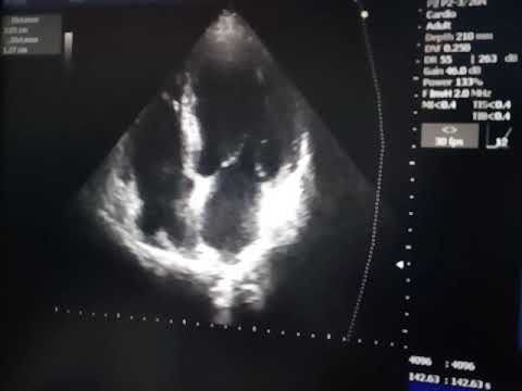 Видео: Гипокинез нижних и латеральных сегментов ЛШ