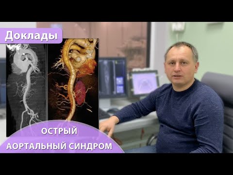 Видео: Острый аортальный синдром - тип A по Stanford: МДКТ восходящей аорты - "key points". Андрей Мангов