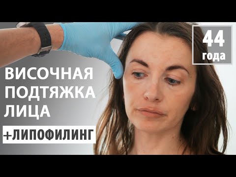 Видео: Подтяжка лица с липофилингом (пациентке 44 года)
