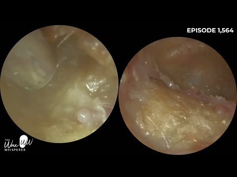 Видео: 1564 — Двусторонняя редкая холестеотома альвеолярного канала. Пациент 2,5 года ждал приёма у ЛОР-...