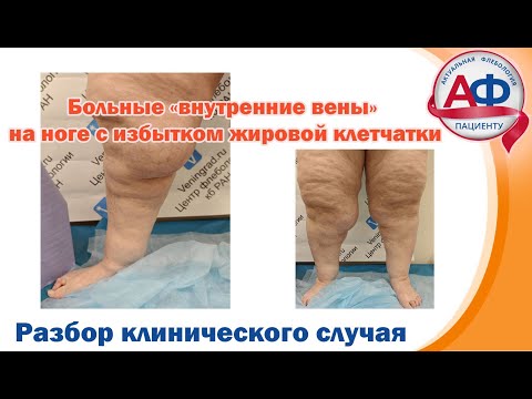 Видео: Больные "внутренние вены" на ногах с избытком жировой клетчатки.