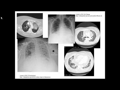 Видео: Боярская Ю.B. «Пневмоцистная пневмония vs люпус-пневмонит (как дебют СКВ) у пациента без ВИЧ»