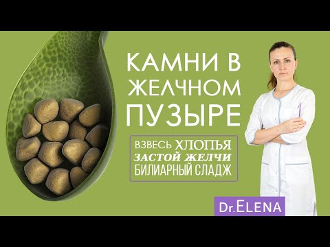 Видео: ЖКБ. Камни в желчном пузыре. Билиарный сладж, застой желчи, хлопья в желчном пузыре. УДХК | Урсосан.