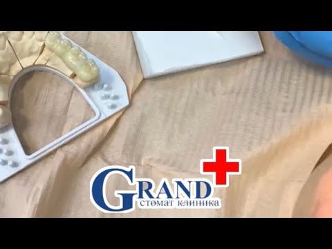 Видео: Фиксация мостовидных протезов из диоксида циркония Стоматологическая Клиника GRAND +380664179190