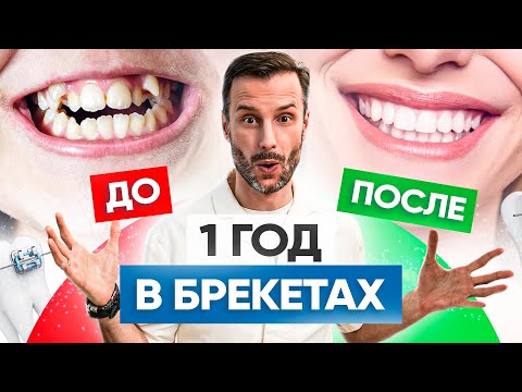 Видео: Брекеты До и После – 5 реальных примеров сложных работ в клинике OrthoLike