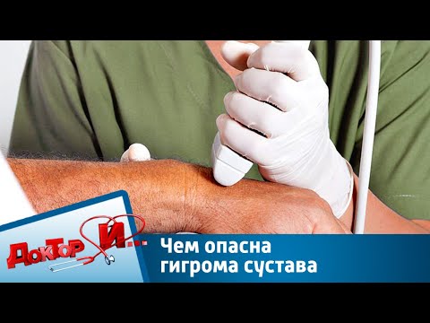 Видео: Чем опасна гигрома сустава | Доктор И