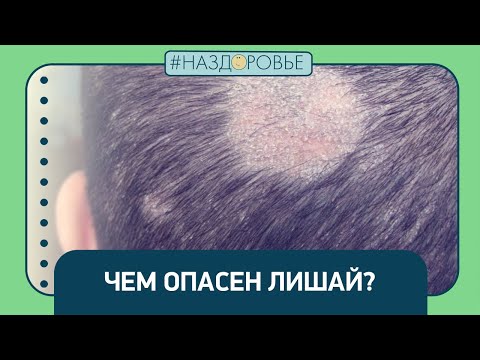 Видео: #НАЗДОРОВЬЕ: чем опасен лишай