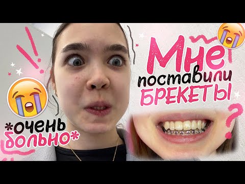 Видео: VLOG 😱 Мне ПОСТАВИЛИ БРЕКЕТЫ *очень больно*