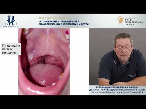 Видео: Клинические проявления и ошибки диагностики неходжкинских лимфом у детей. Часть 2.