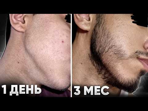 Видео: Запустил рост бороды с полного нуля. Помог этот лосьон для роста волос