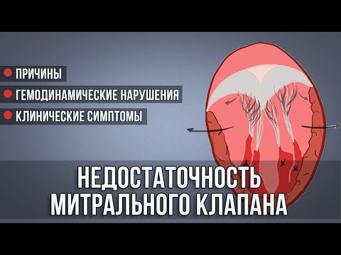 Видео: Недостаточность митрального клапана │ Симптомы, гемодинамика, клиника