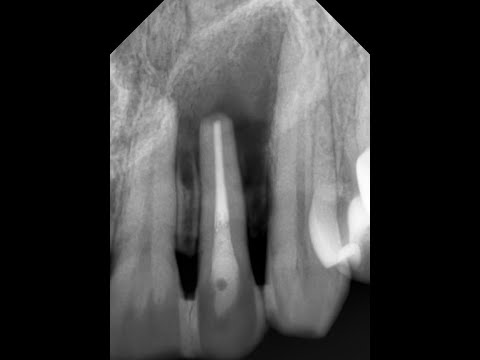 Видео: Апикотомия. Новые тренды, часть 2. Резекция верхушки корня зуба. Ретроградное пломбирование.