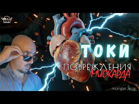 Видео: Элевация или депрессия ST? Токи повреждения миокарда!