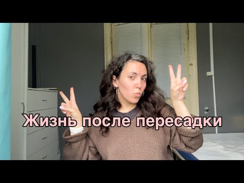 Видео: Полтора года после пересадки волос | андрогенная алопеция 