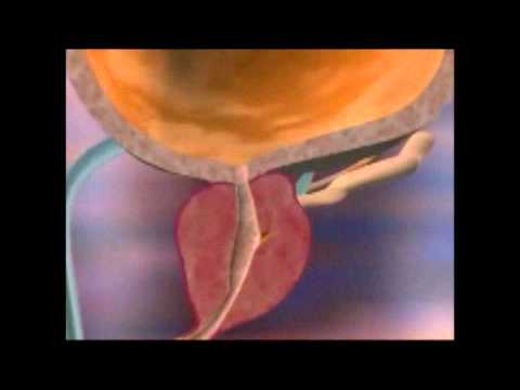 Видео: Лазерно лечение на простата в Токуда Болница